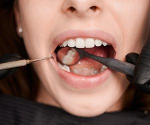 Tooth Extraction